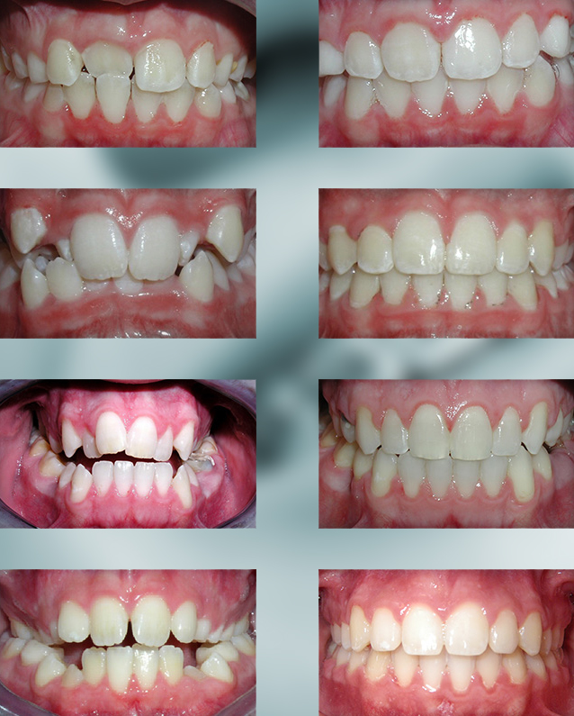 Michael-Riordan-Orthodontics-cross-bite