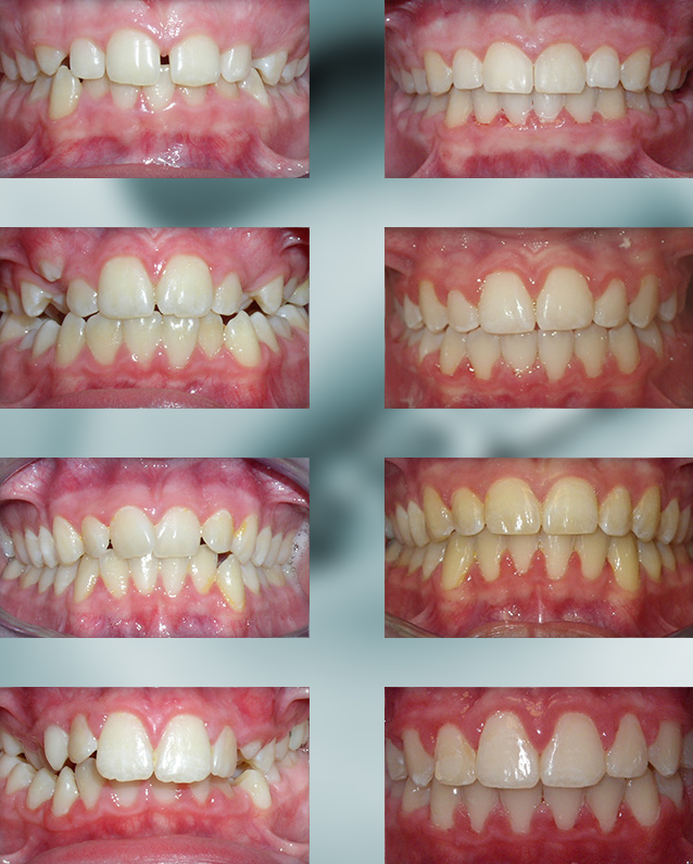 Michael-Riordan-Orthodontics-midline