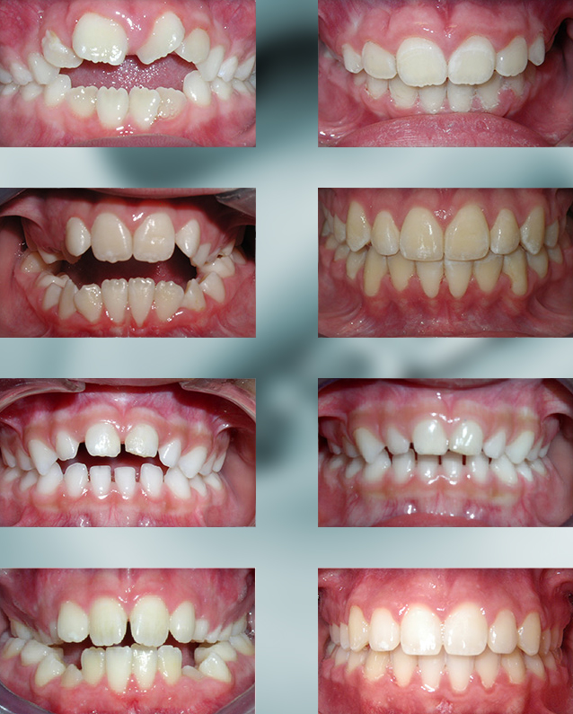 Michael-Riordan-Orthodontics-open-bite
