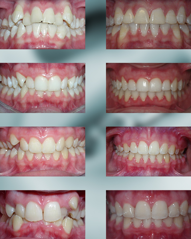 Michael-Riordan-Orthodontics-over-crowding