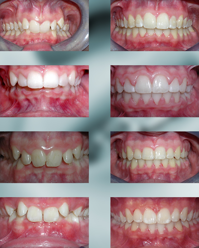 Michael-Riordan-Orthodontics-overbite