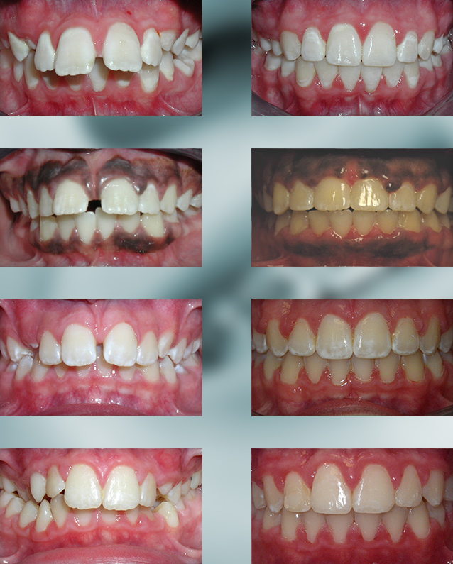 Michael-Riordan-Orthodontics-protrusion