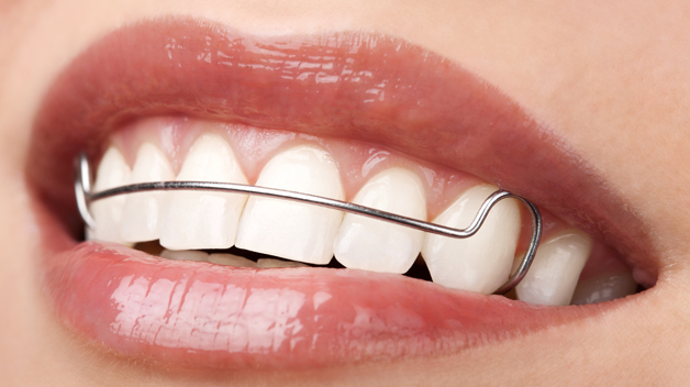 Michael-Riordan-Orthodontics-retainer