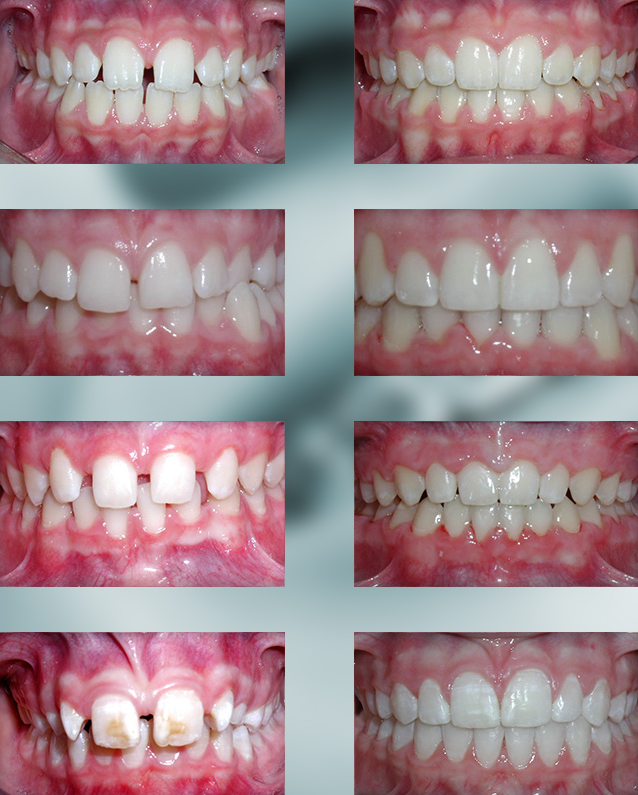 Michael-Riordan-Orthodontics-spacing