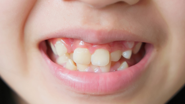 Michael-Riordan-Orthodontics-teeth-crowding