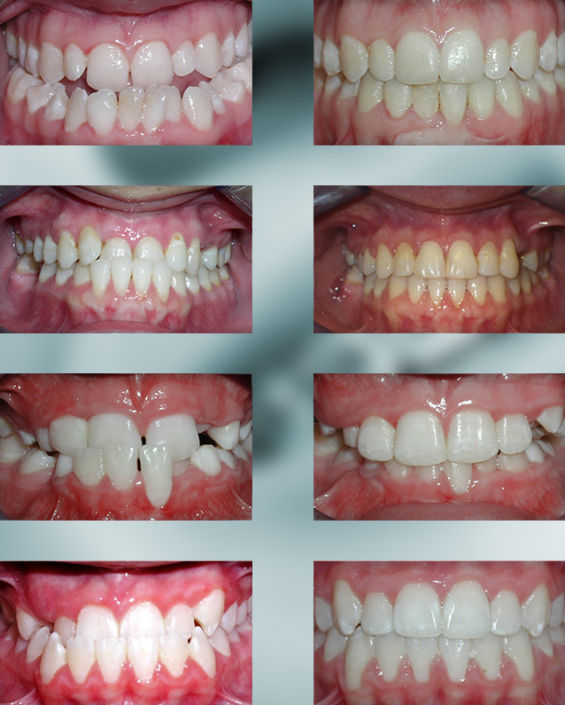 Michael-Riordan-Orthodontics-underbite